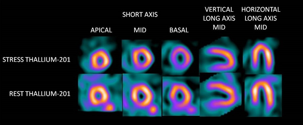 thallium-201-for-myocardial-perfusion-imaging-lantheus