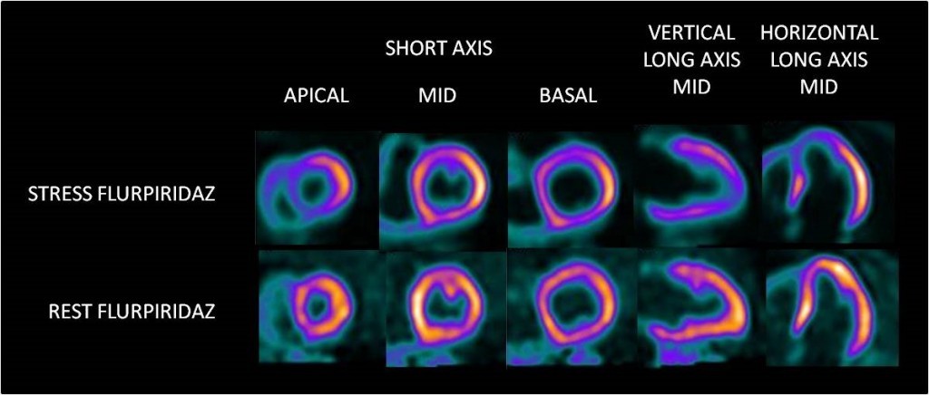 Flurpiridaz F 18 PET Imaging Agent | Lantheus